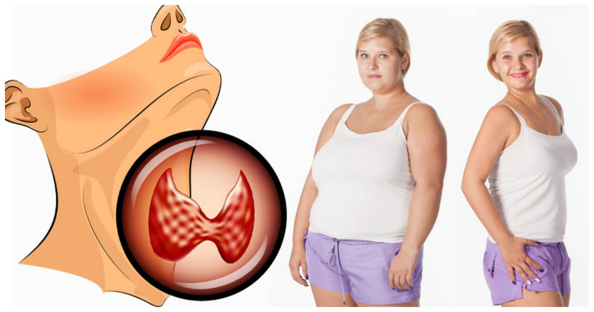 Увеличенная Щитовидная Железа И Лишний Вес