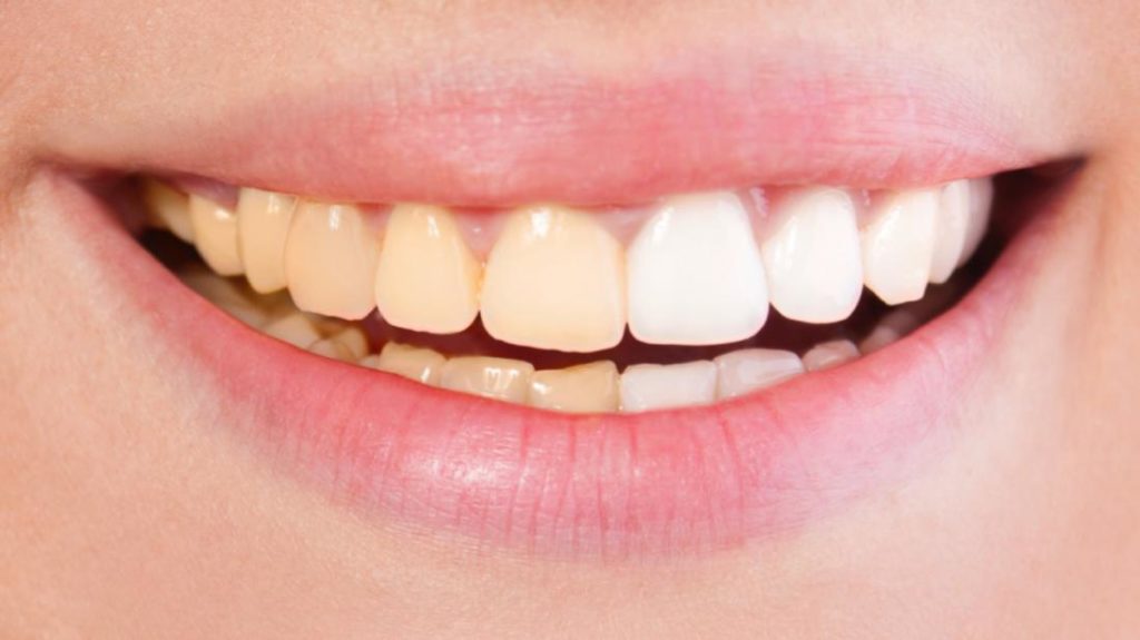 Белые зубы в домашних условиях - 8 хитростей.