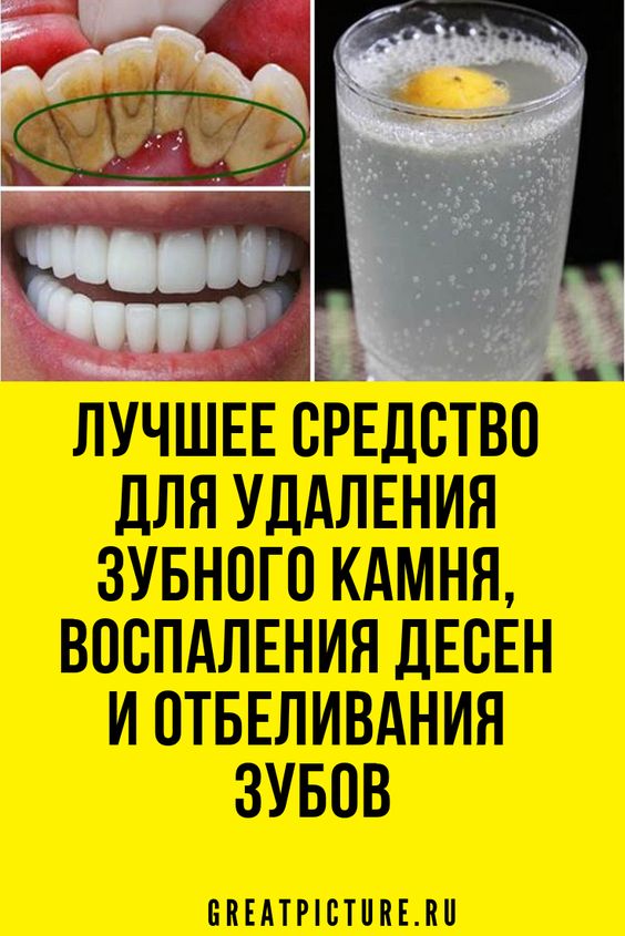 Лучшее средство для удаления зубного камня,и отбеливания зубов