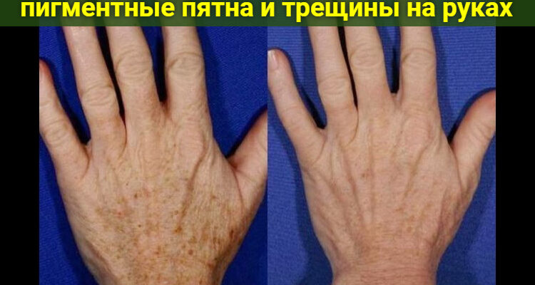 Эта простая мазь убирает морщины, пигментные пятна и трещины на руках