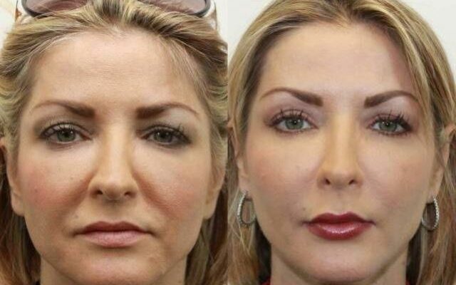 Даже очень дряблая кожа лица после этой процедуры подтянется! Делайте это 1 раз в неделю