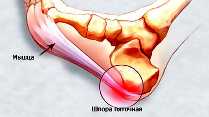 Рецепты от шпор на пятке. Пяточная шпора: причины, симптомы и лечение шпоры на пятке Проверенный рецепт от подписчицы. Избавляемся от пяточной шпоры. Ищите Мазь от шпор на пятках? Лучшие производители +Рецепты в домашних.