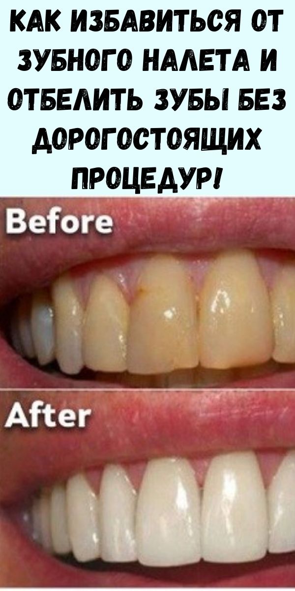 Как избавиться от зубного налета и отбелить зубы без дорогостоящих процедур!
