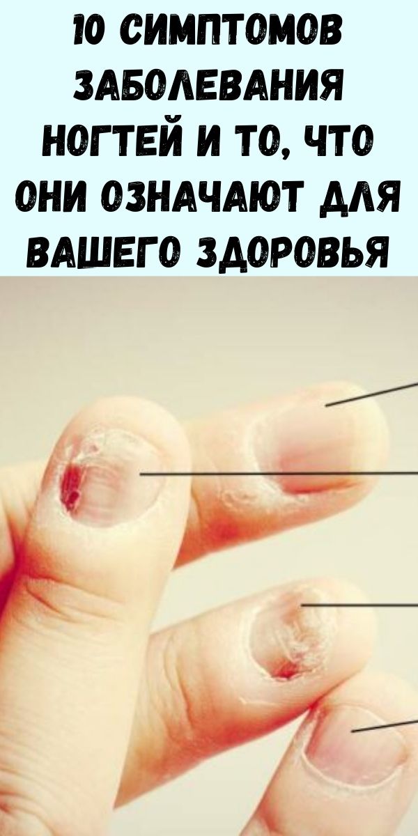 10 симптомов заболевания ногтей и то, что они означают для вашего здоровья