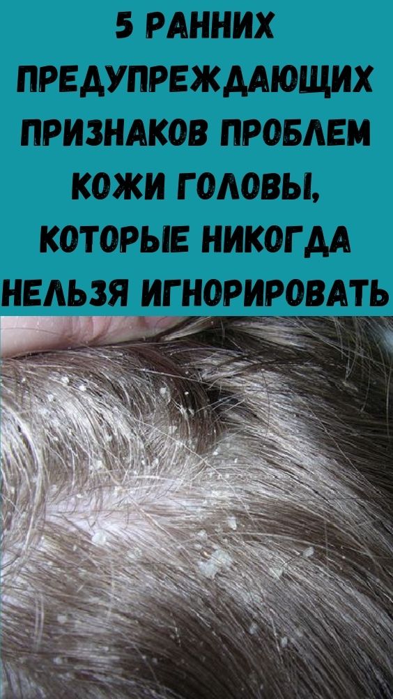 5 ранних предупреждающих признаков проблем кожи головы, которые никогда нельзя игнорировать