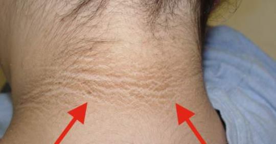 2 эффективных способа устранения потемнения кожи шеи