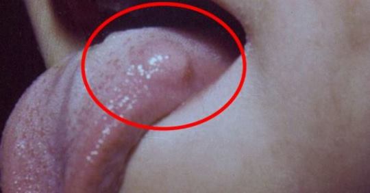 Симптомы инфекции ленточного червя, которые часто упускают из виду