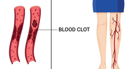 10 ранних предупреждающих симптомов сгустка крови, которые вы никогда не должны игнорировать