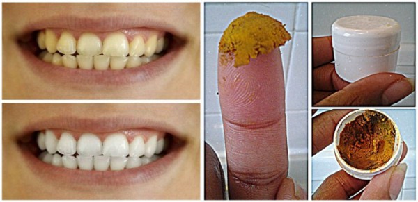 Рецепт зубной пасты из куркумы для лечения кариеса и естественного отбеливания зубов