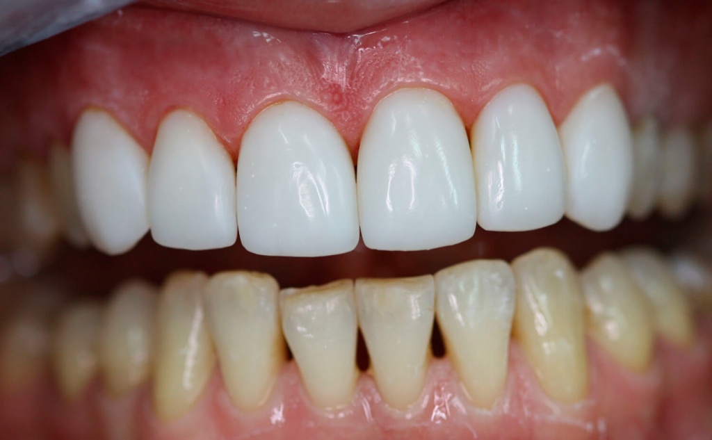 Что такое виниры и зачем они нужны: рекомендации стоматологов